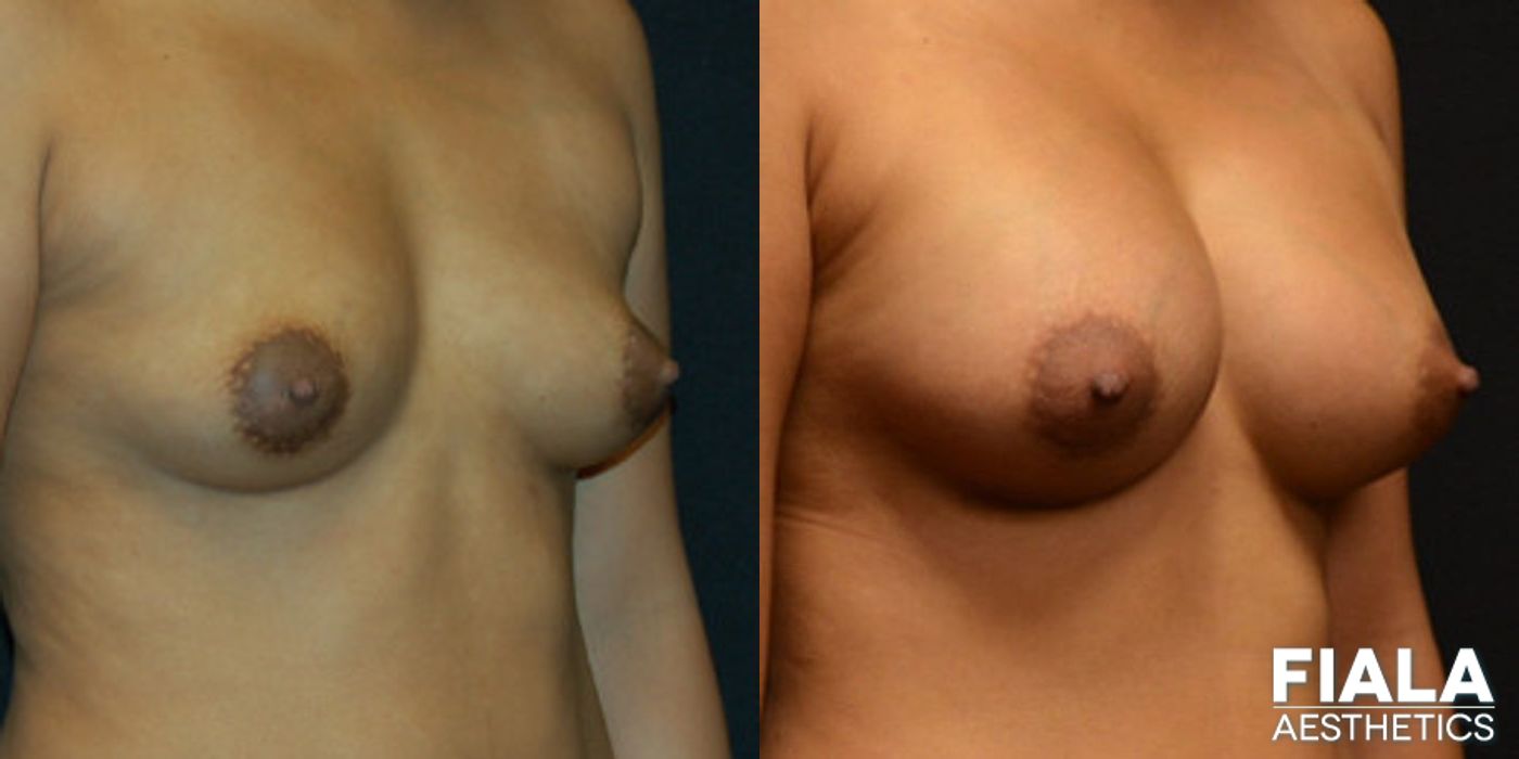 400cc breast implant before after Orlando - Angle 2
