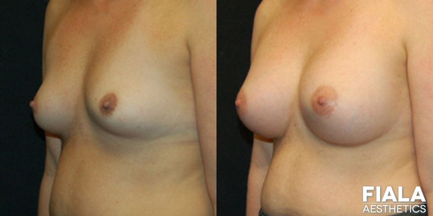 400cc Implants - Thumbnail 2