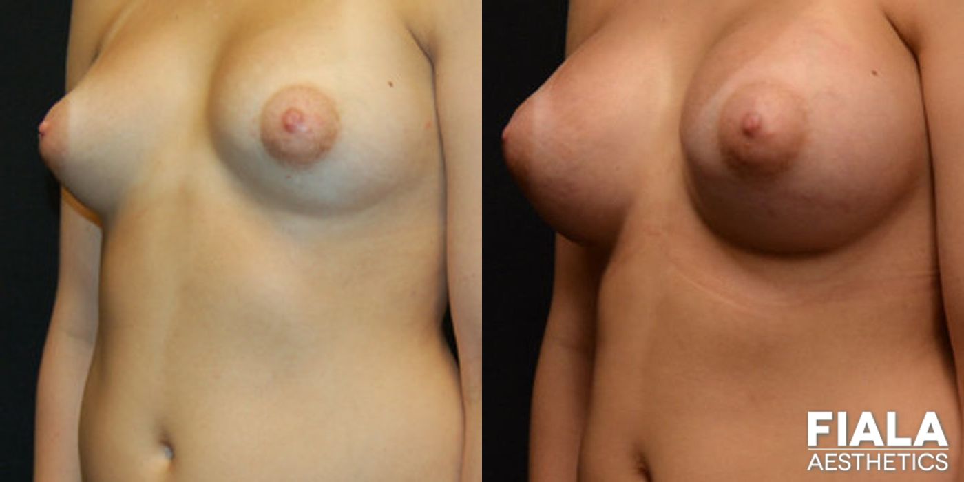 Before and after 400cc Implants case 13709 - Angle 2