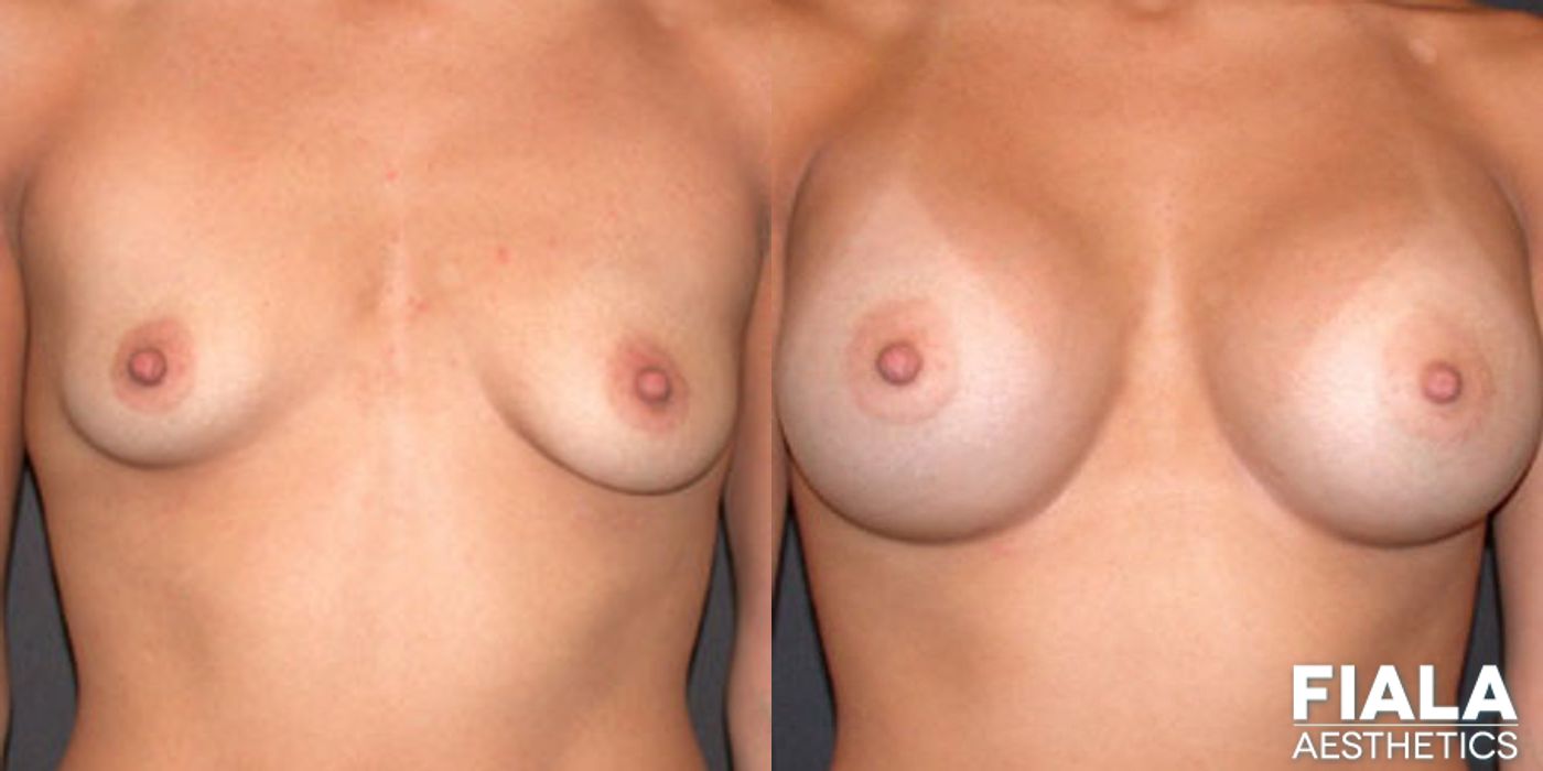 400cc Implants - Case 9142