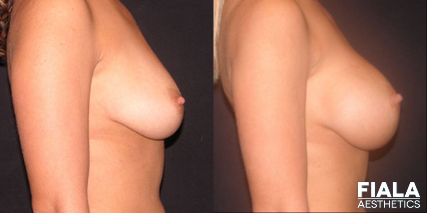 400cc smooth silicone breast implants placed under the muscle using a dual-plane approach - Angle 2