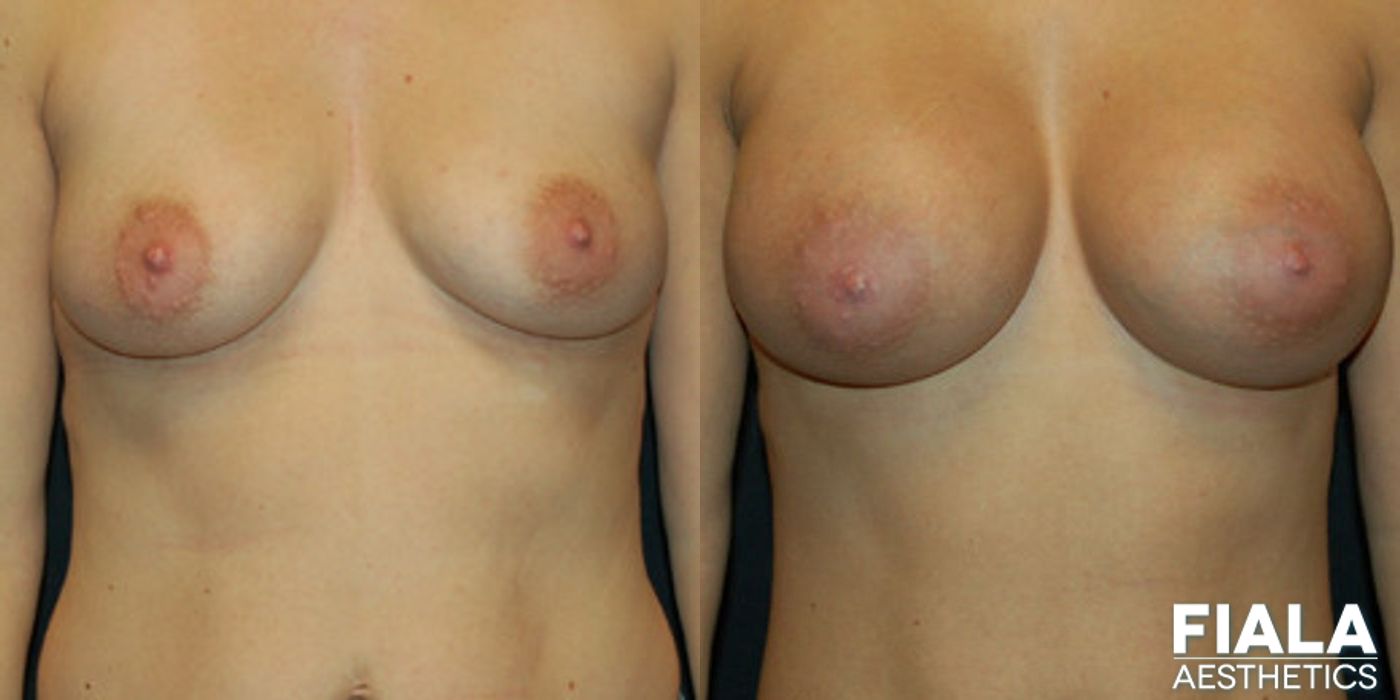 400cc Implants - Thumbnail 2