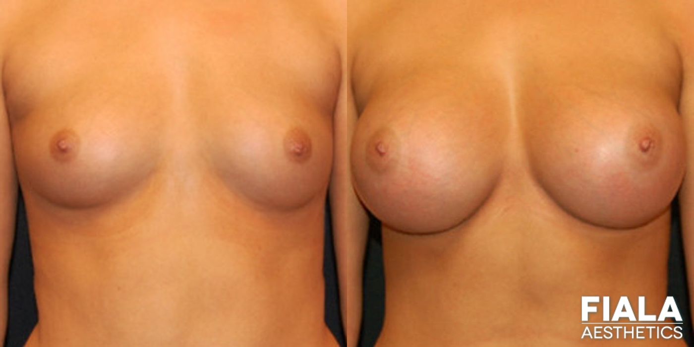 400cc breast implant before after Orlando