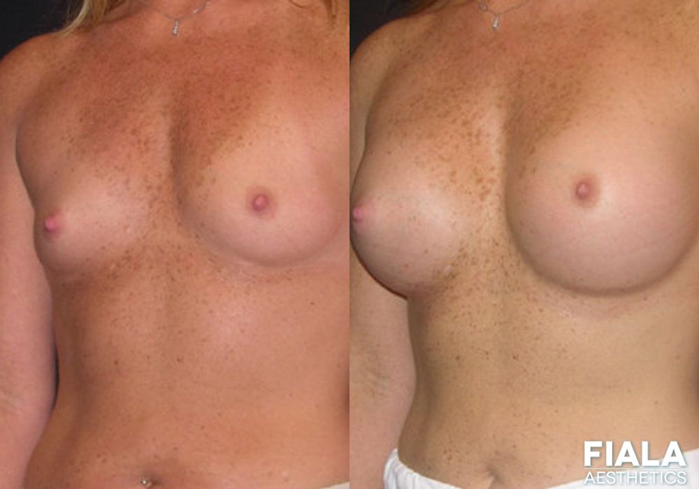 400cc Implants - Thumbnail 2