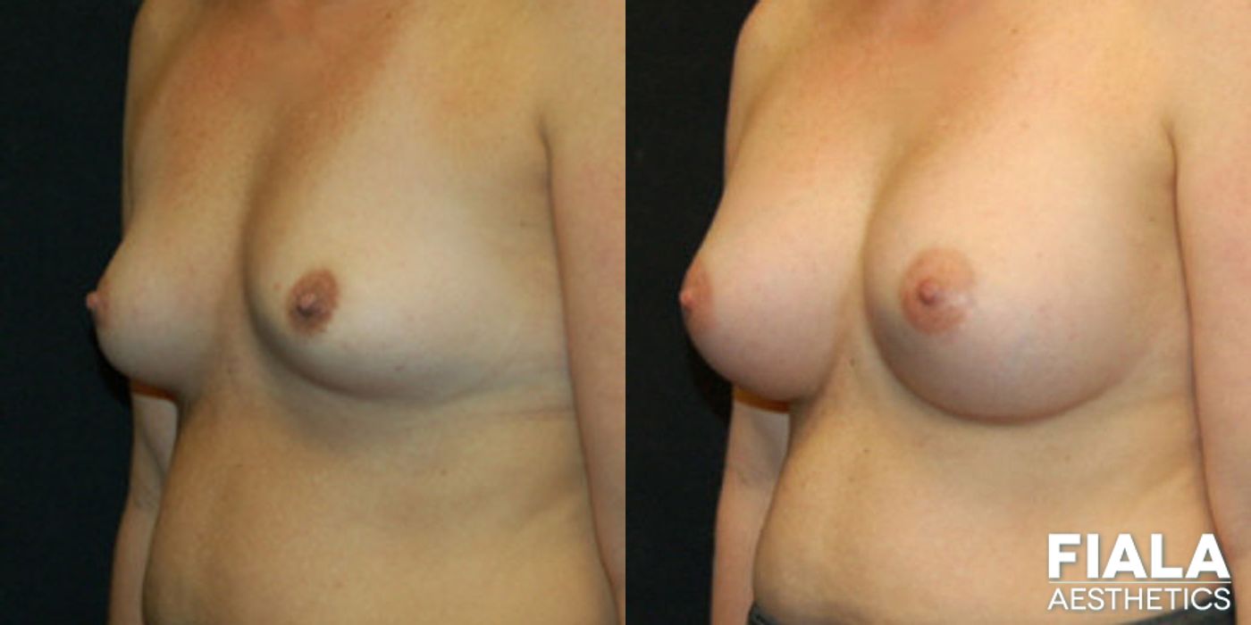 Before and after 400cc Implants case 13720 - Angle 2