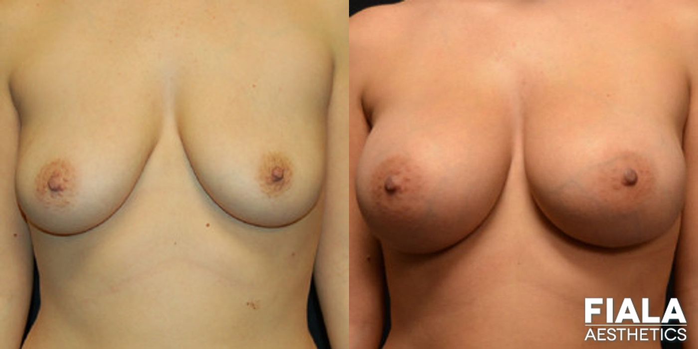 Before and after 400cc Implants case 13716