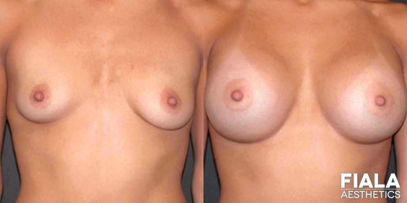 400cc smooth silicone breast implants placed beneath the muscle via dual plane approach through a 4cm inframammary incision