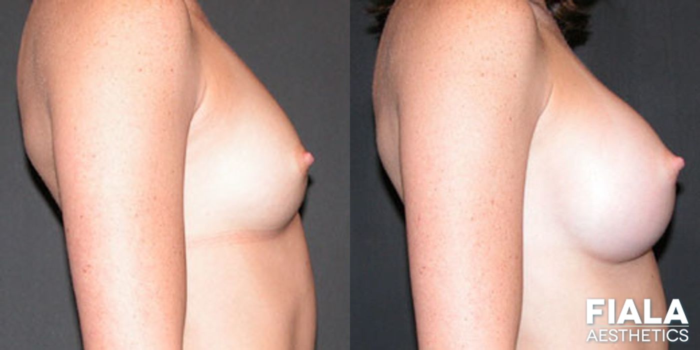 Before and after 400cc Implants case 14111 - Angle 2