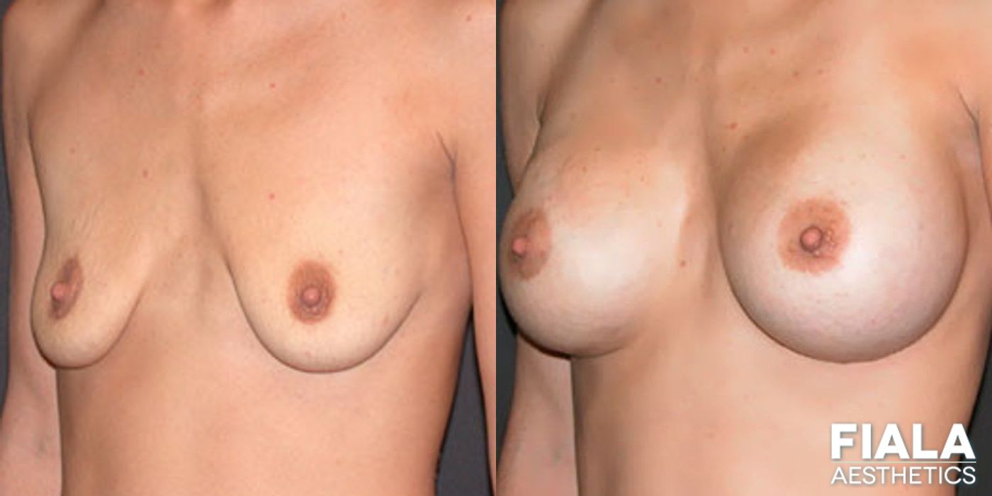 Before and after 400cc Implants case 13704 - Angle 2