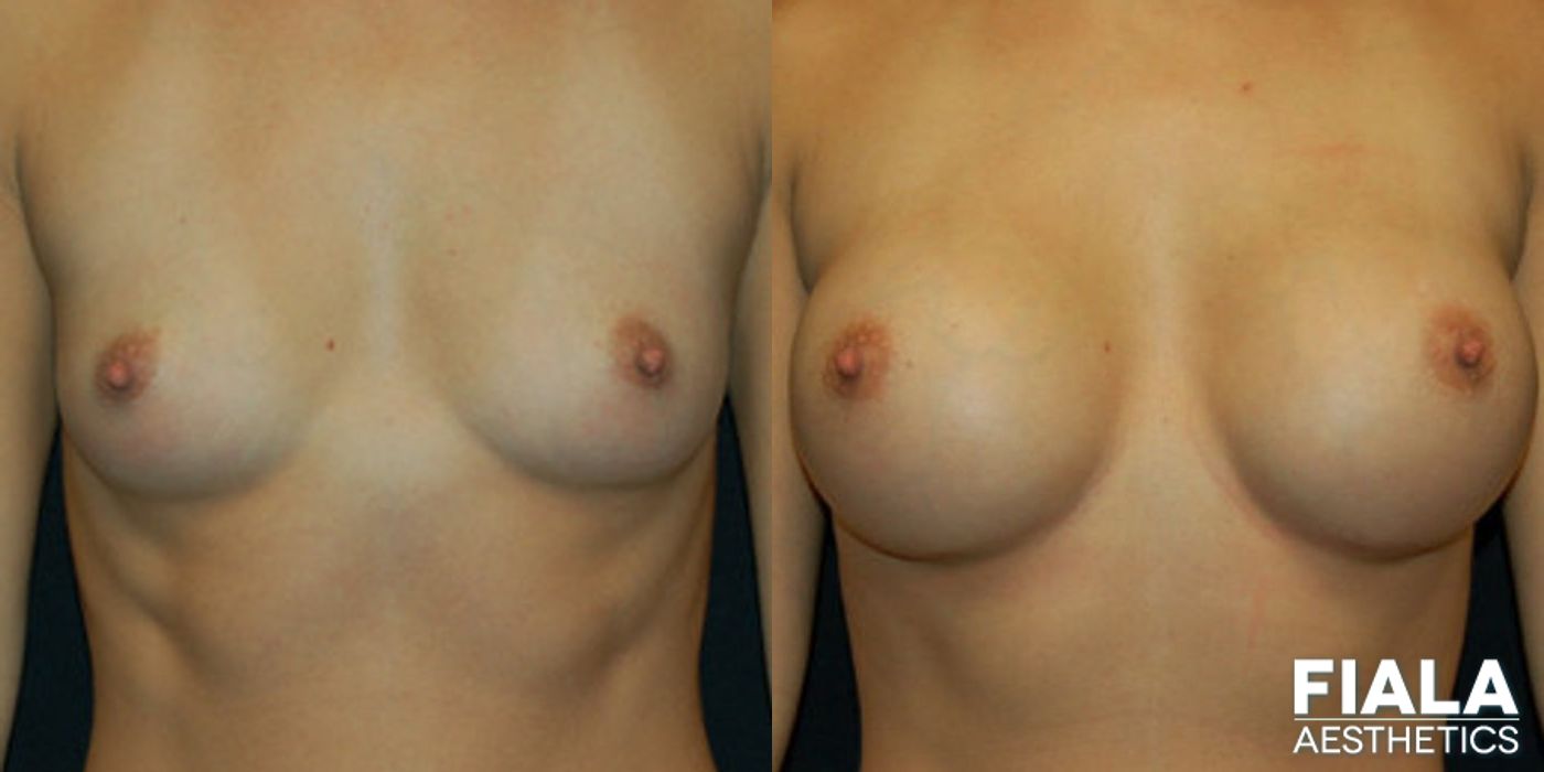 Before and after 400cc Implants case 13712