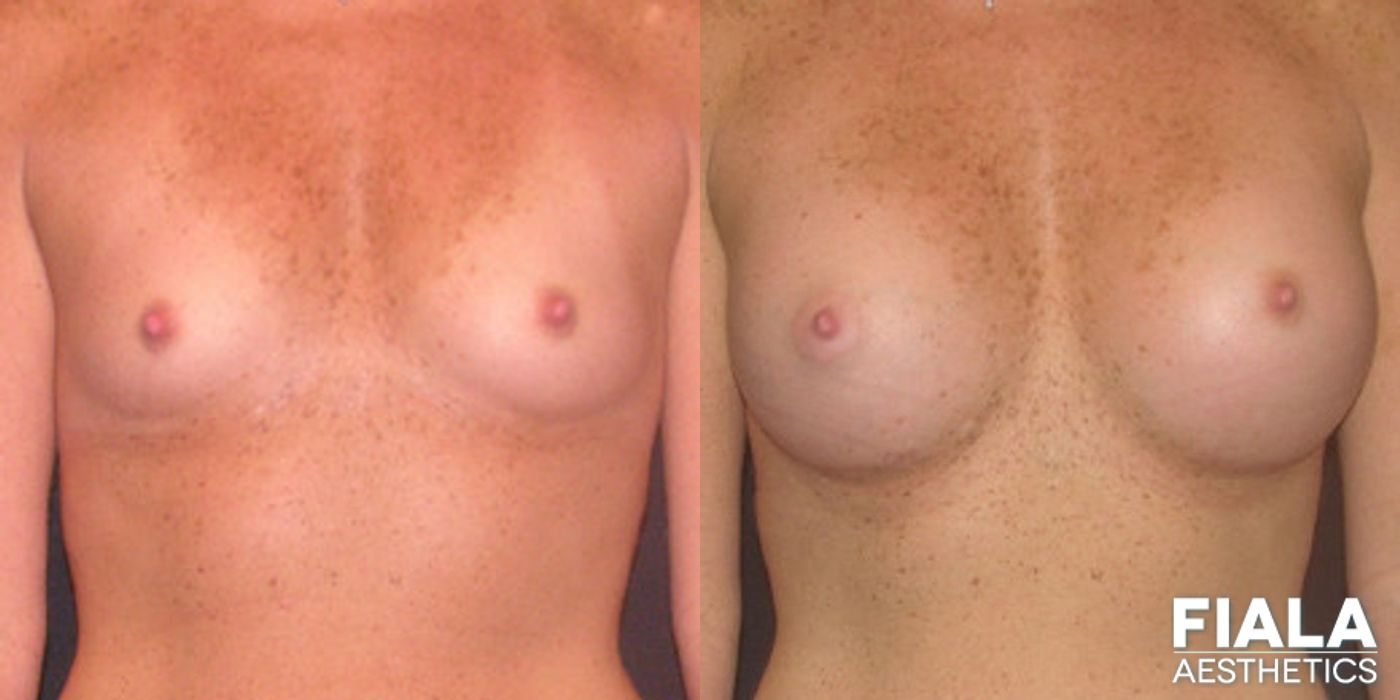 Before and after 400cc Implants case 13713