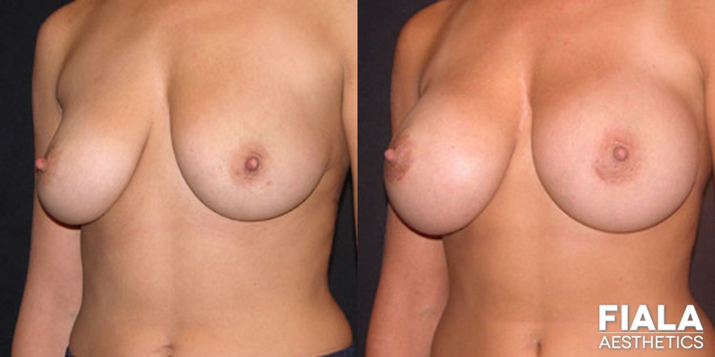 Before and after 400cc Implants case 13721 - Angle 2