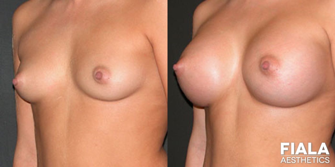 Before and after 400cc Implants case 13702