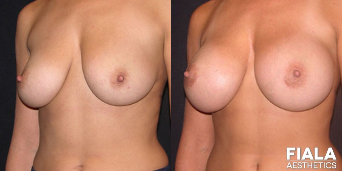 400cc Implants - Thumbnail 2