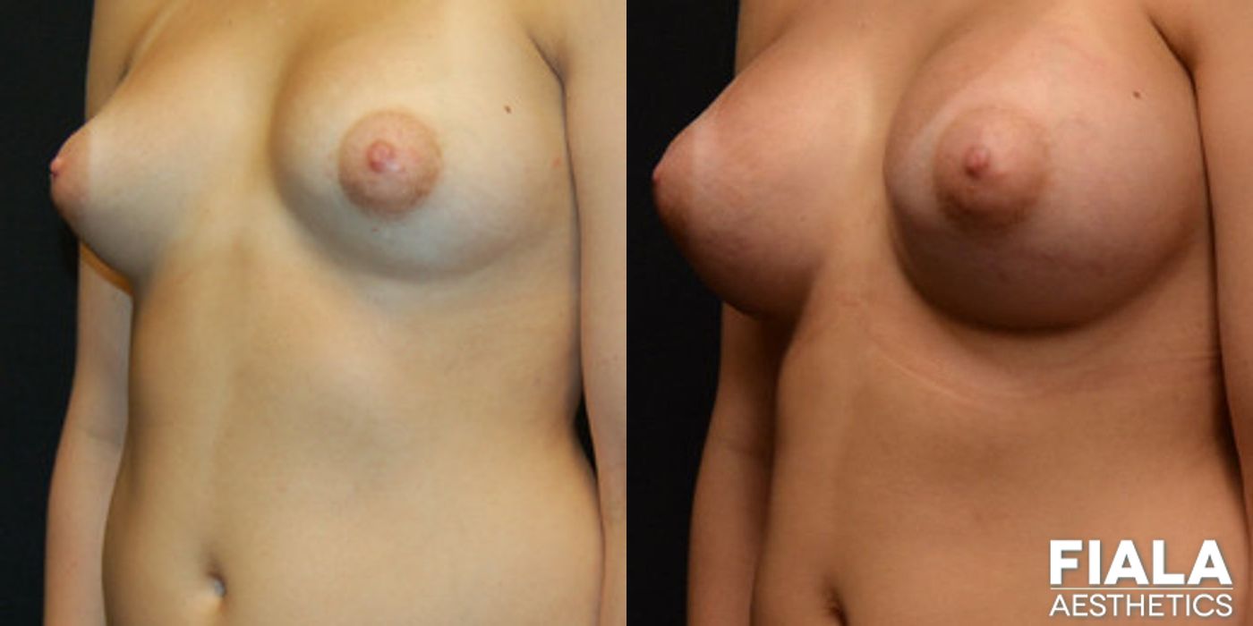 400cc Implants - Thumbnail 2