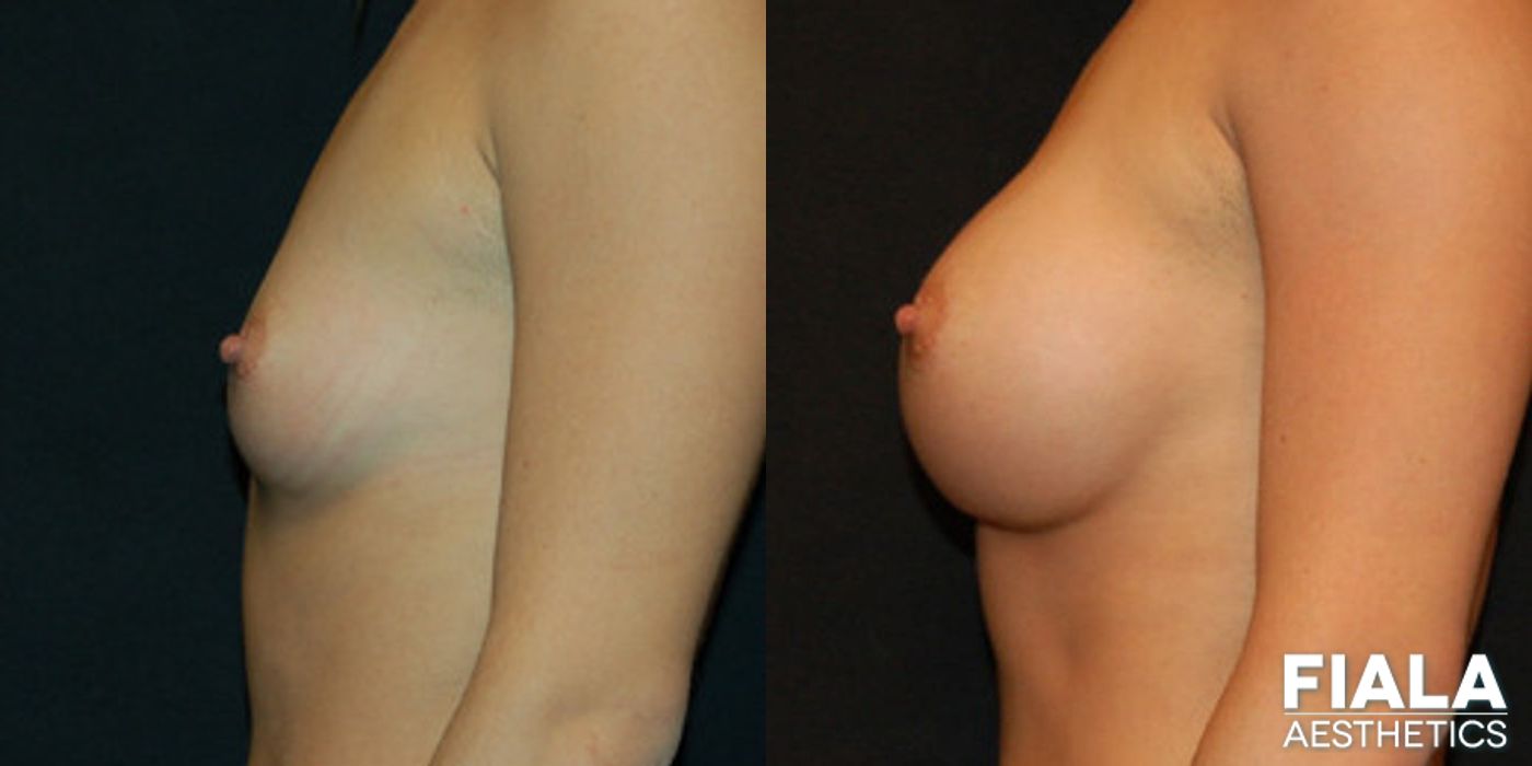 Before and after 400cc Implants case 13712 - Angle 2
