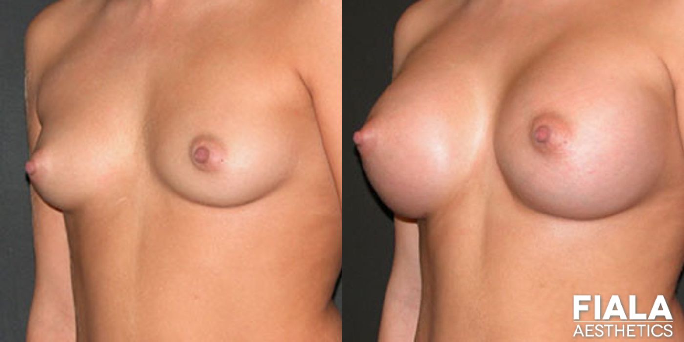 400cc Implants - Case 9132