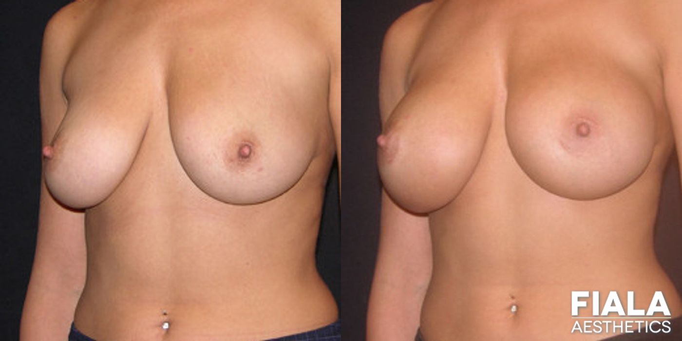 400cc smooth silicone breast implants placed under the muscle using a dual-plane approach