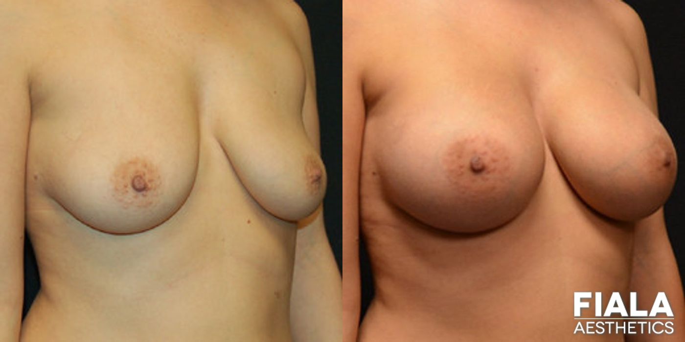 Before and after 400cc Implants case 13716 - Angle 2