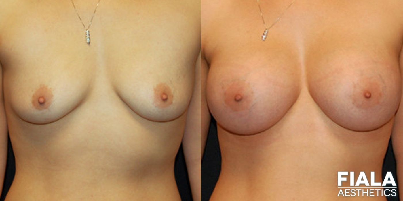 Before and after 500cc Implants case 13725