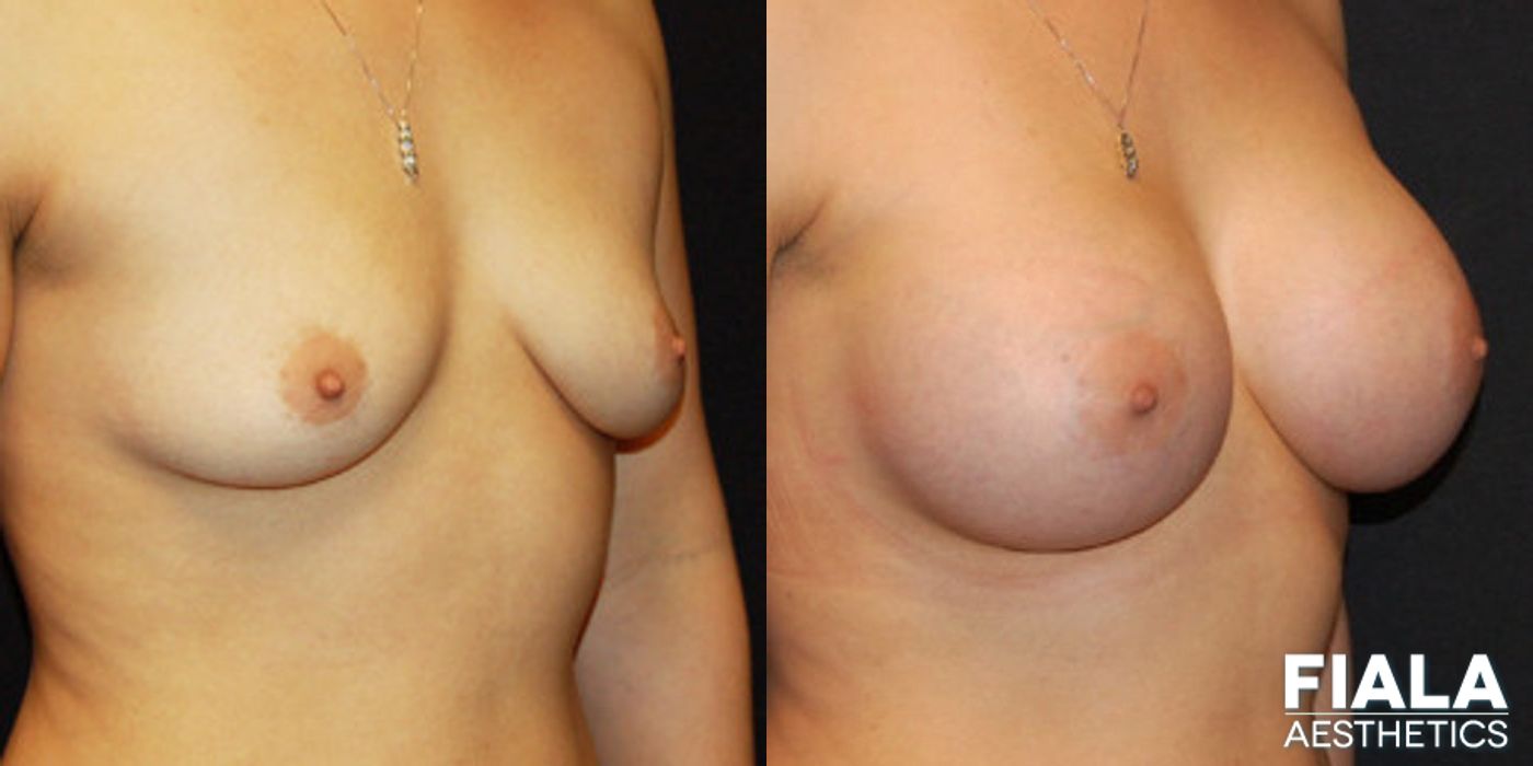Before and after 500cc Implants case 13725 - Angle 2