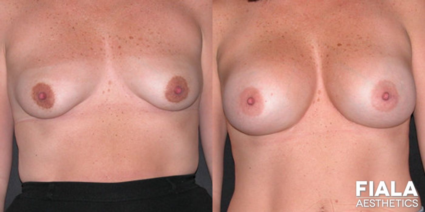 500cc smooth silicone breast implants placed via inframammary incision using a Keller funnel by Dr. Fiala in Orlando