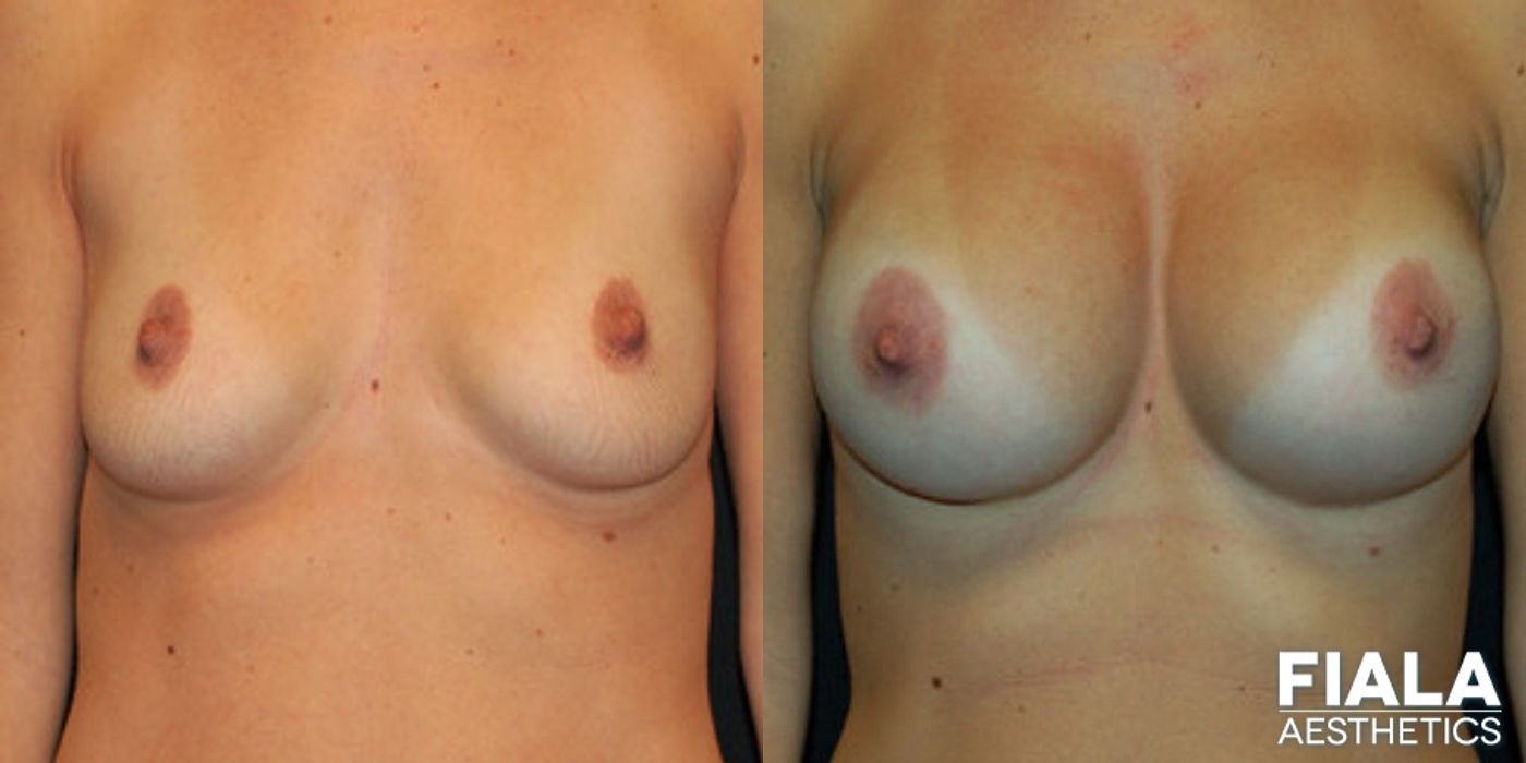 500cc smooth silicone breast implants placed beneath the pectoral muscle using the dual plane technique by Dr. Fiala in Orlando