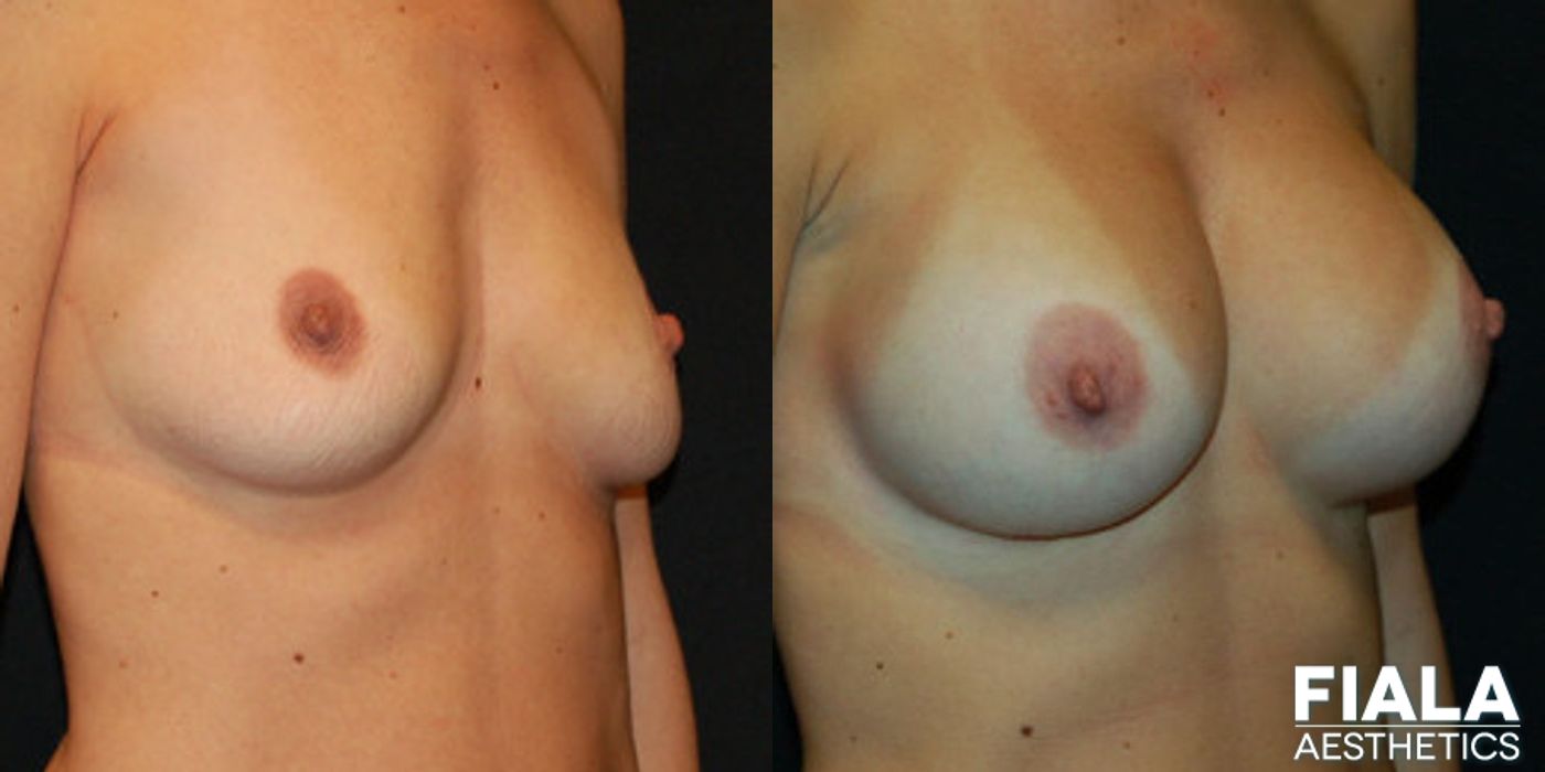 500cc Implants - Thumbnail 2