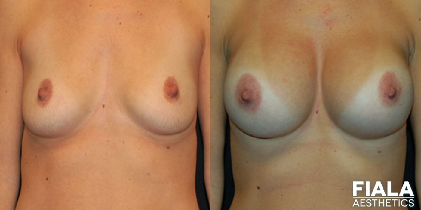 500cc Implants - Case 9154