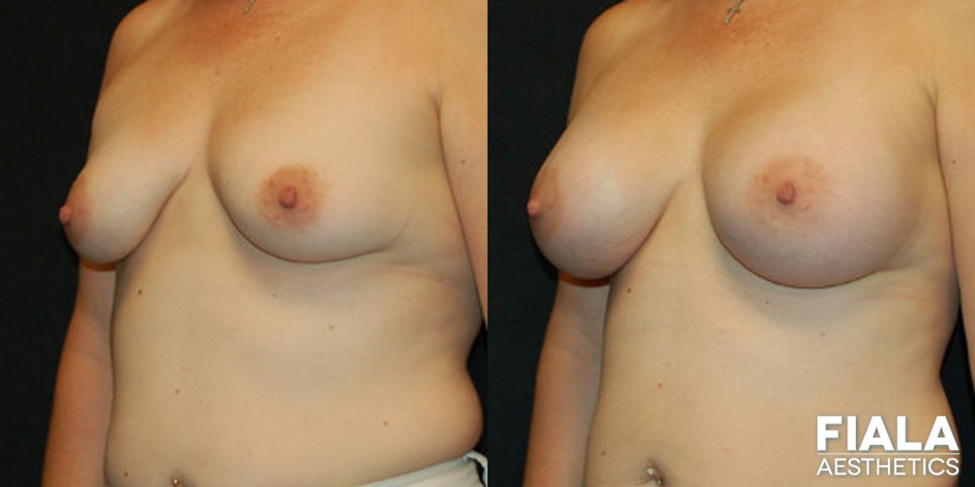 Before and after 500cc Implants case 13724 - Angle 2