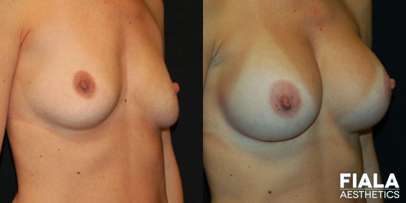 500cc smooth silicone breast implants placed beneath the pectoral muscle using the dual plane technique by Dr. Fiala in Orlando - Angle 2