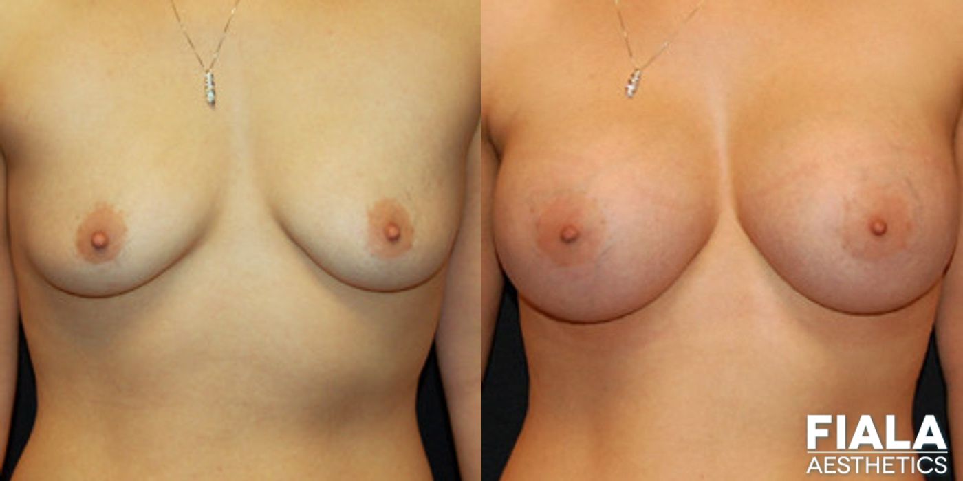 500cc Implants - Case 9153