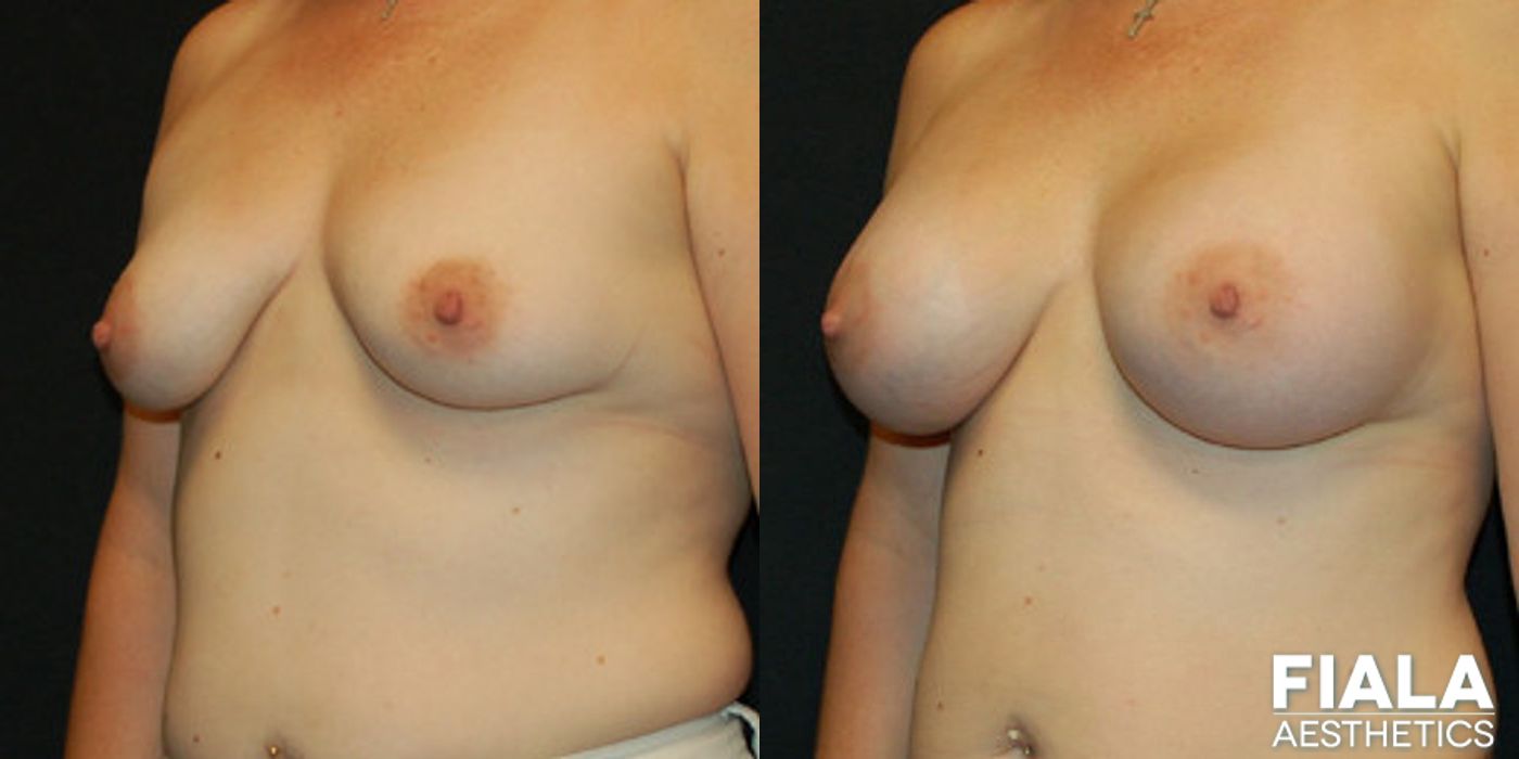 500cc Implants - Thumbnail 2