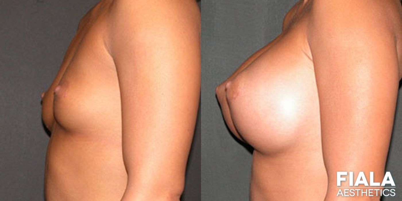 Before and after 600cc Implants case 13728 - Angle 2