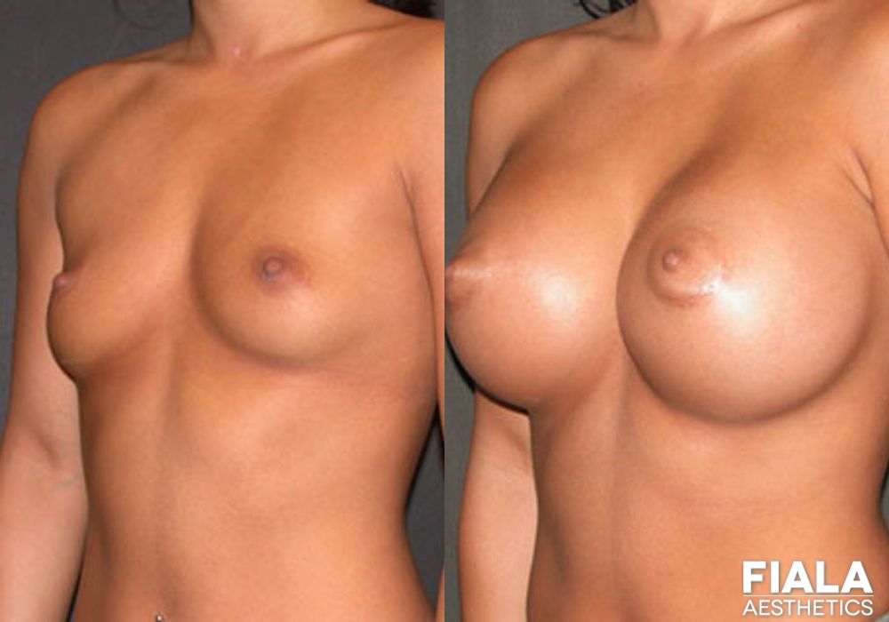 600cc Implants - Case 8935