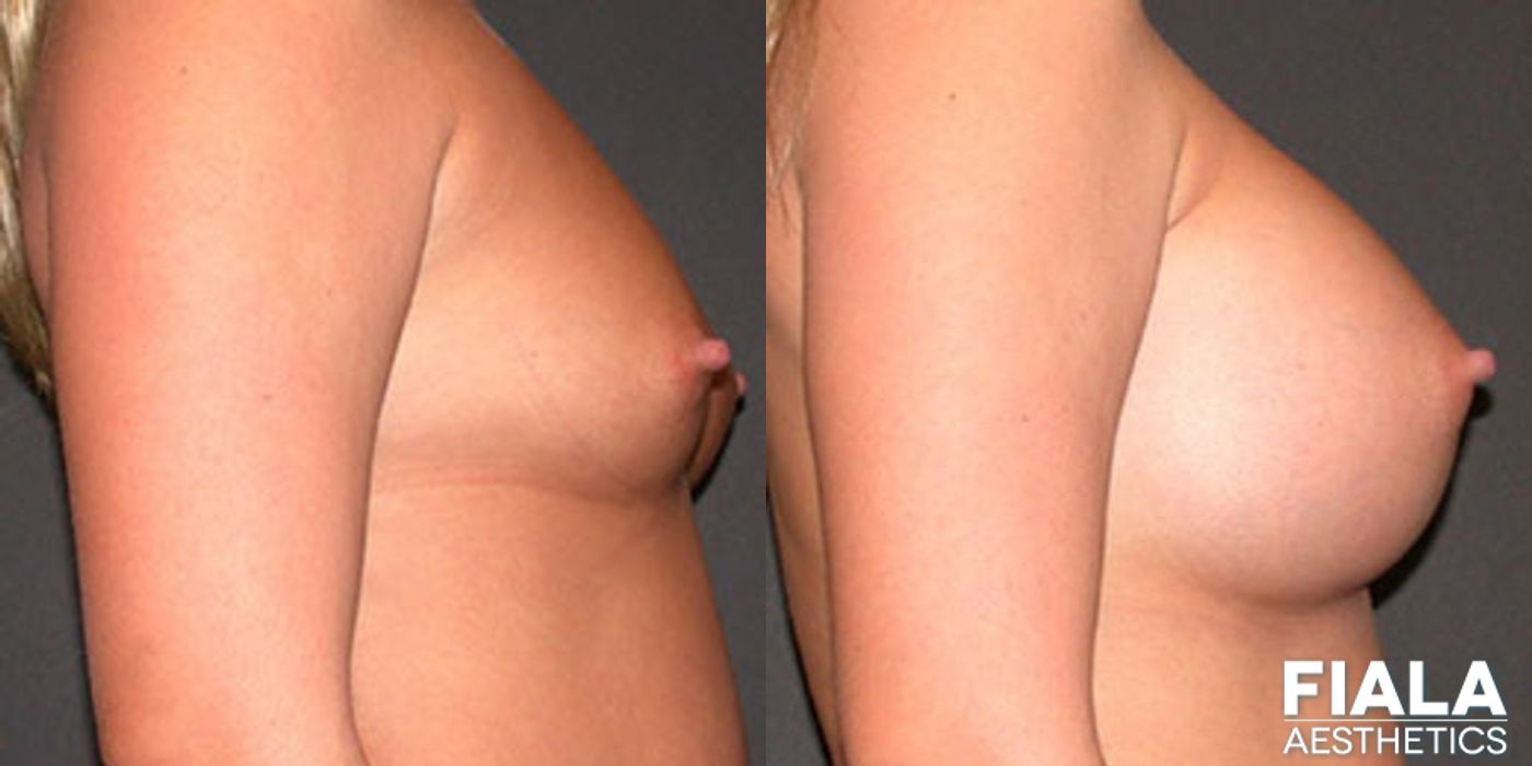 600cc Implants - Thumbnail 2