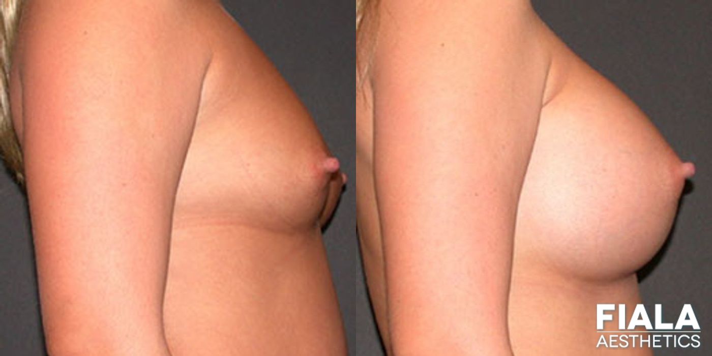 Before and after 600cc Implants case 13729 - Angle 2