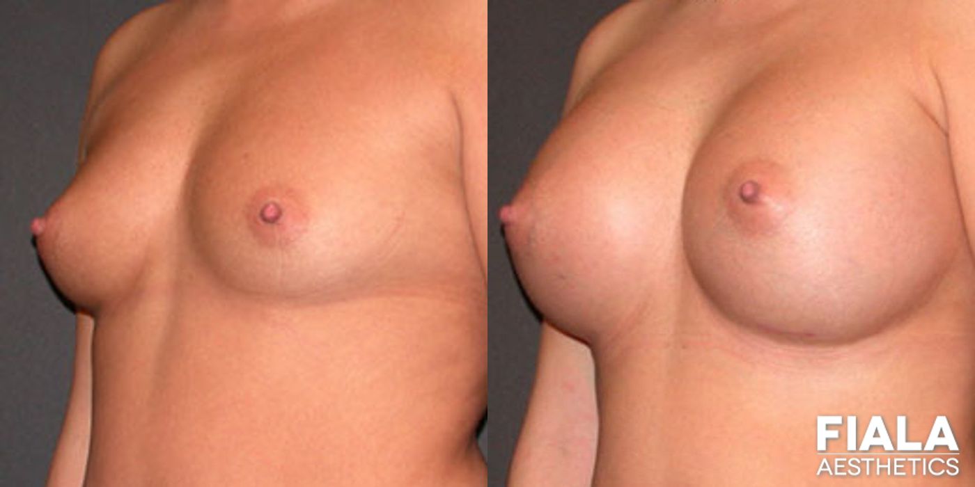 Before and after 600cc Implants case 13729