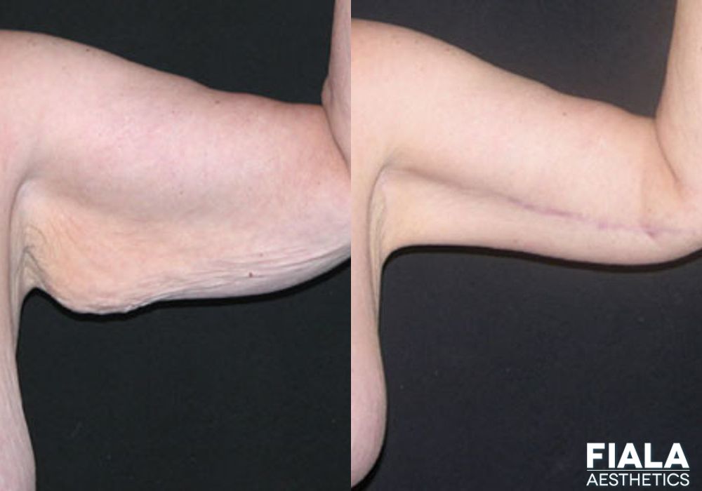 Arm Lift - Case 8874