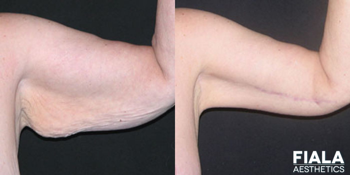 Arm Lift - Case 9049