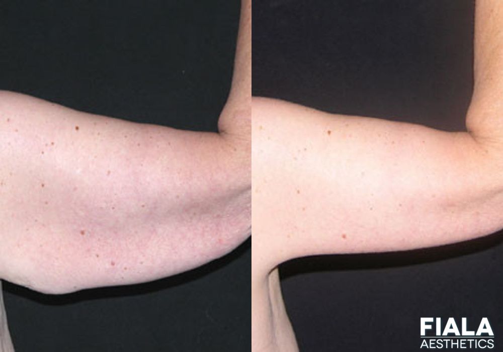 Arm Lift - Thumbnail 2