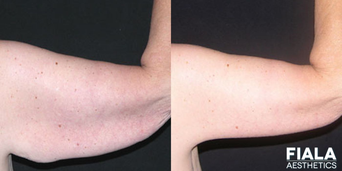 Arm Lift - Thumbnail 2