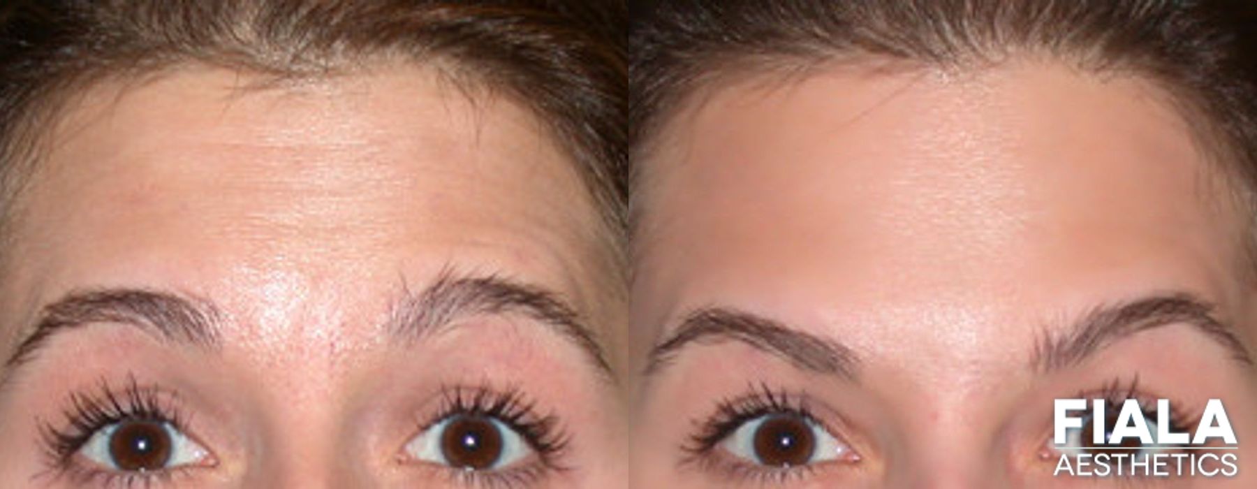 Before and after BOTOX Cosmetic case 13912