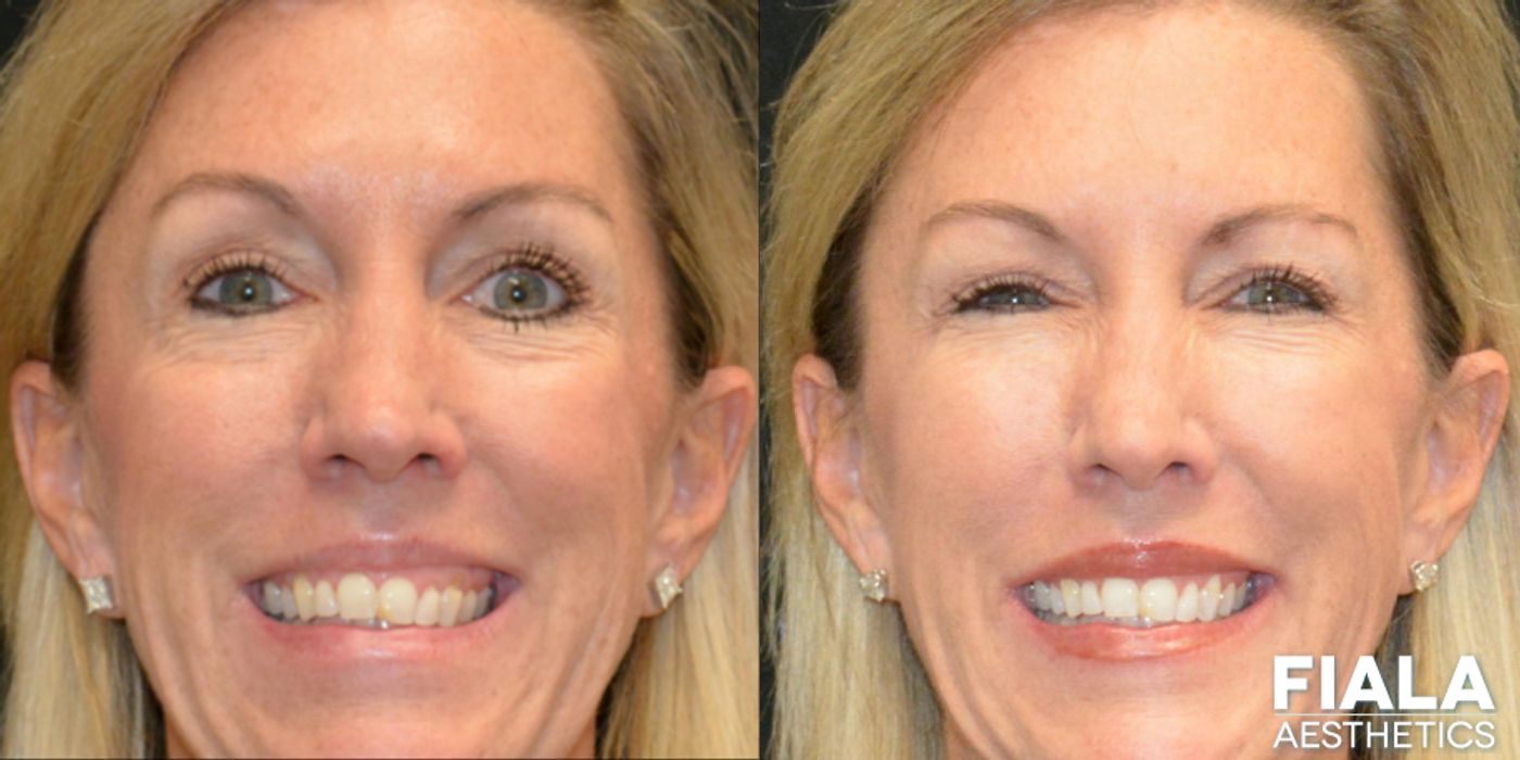 BOTOX Cosmetic - Thumbnail 4