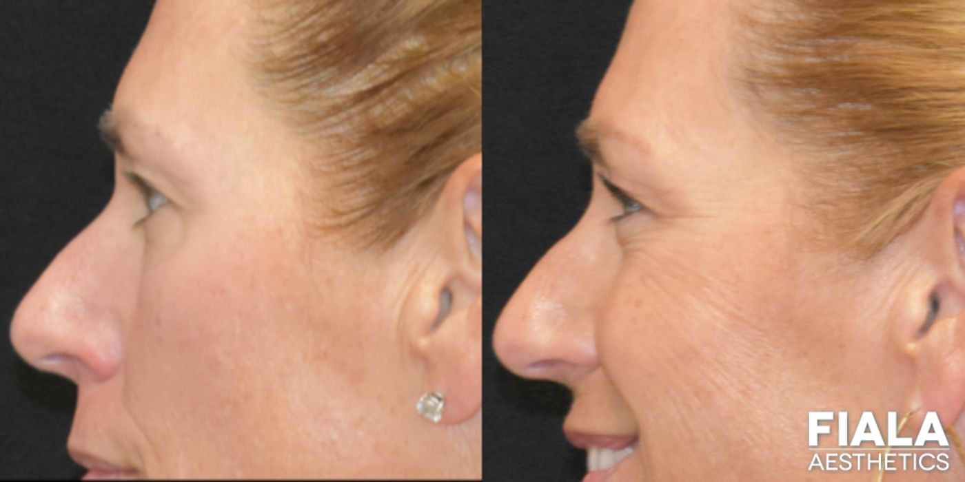 Before and after BOTOX Cosmetic case 13914 - Angle 8