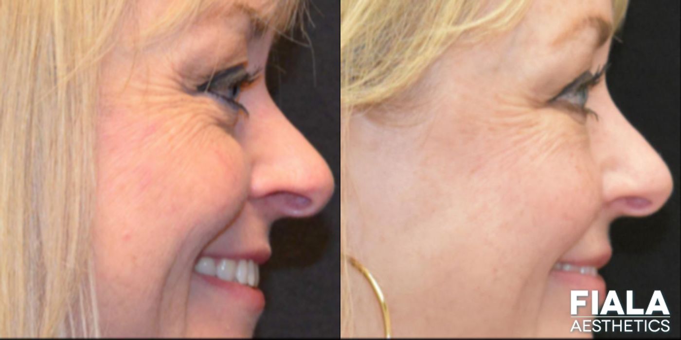 Before and after BOTOX Cosmetic case 13944 - Angle 4