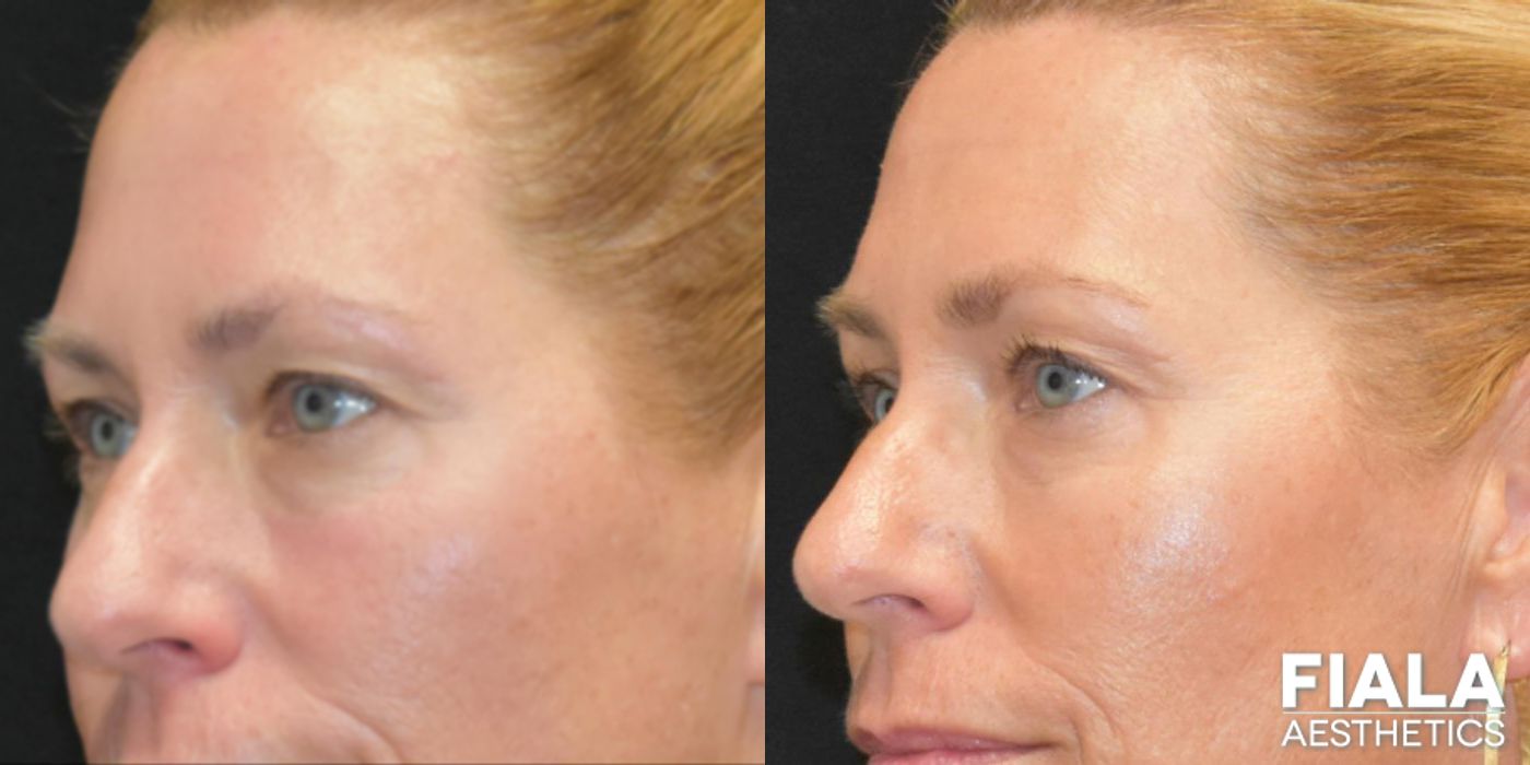 Before and after BOTOX Cosmetic case 13914 - Angle 7
