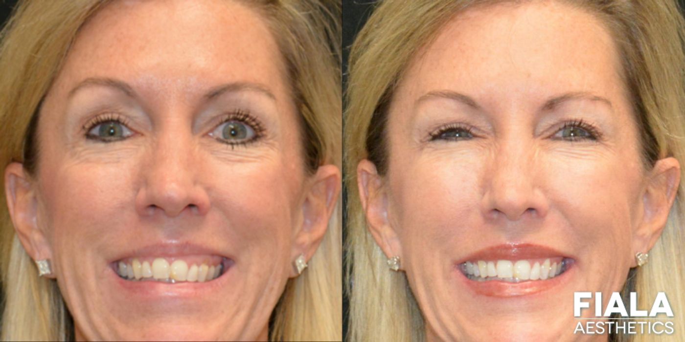 Before and after Dermal Fillers case 13916 - Angle 4