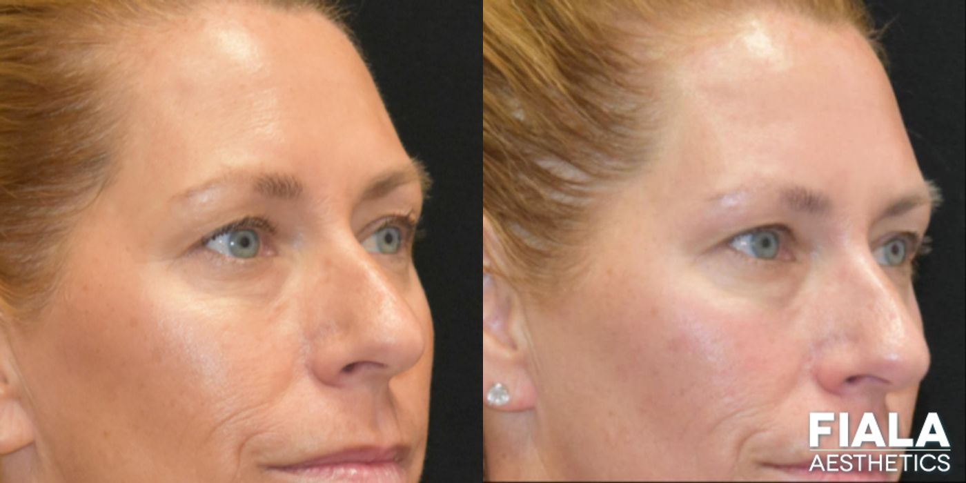 Before and after BOTOX Cosmetic case 13914 - Angle 4