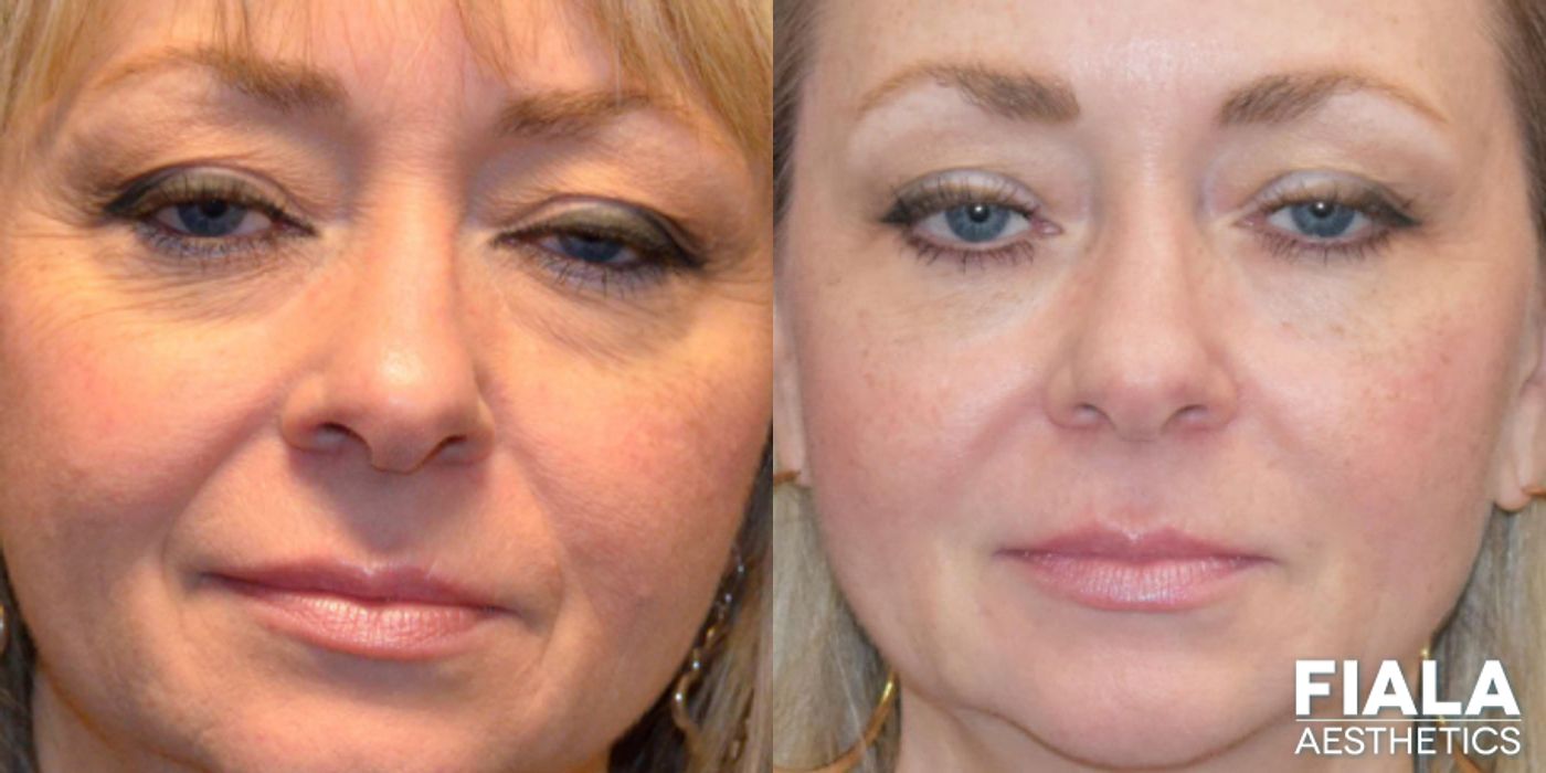 Before and after BOTOX Cosmetic case 13944 - Angle 2